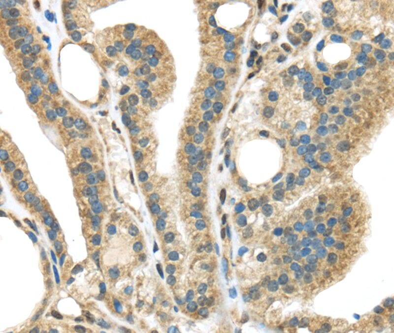 Immunohistochemical analysis of paraffin-embedded Human thyroid cancer tissue using #40376 at dilution 1/45.