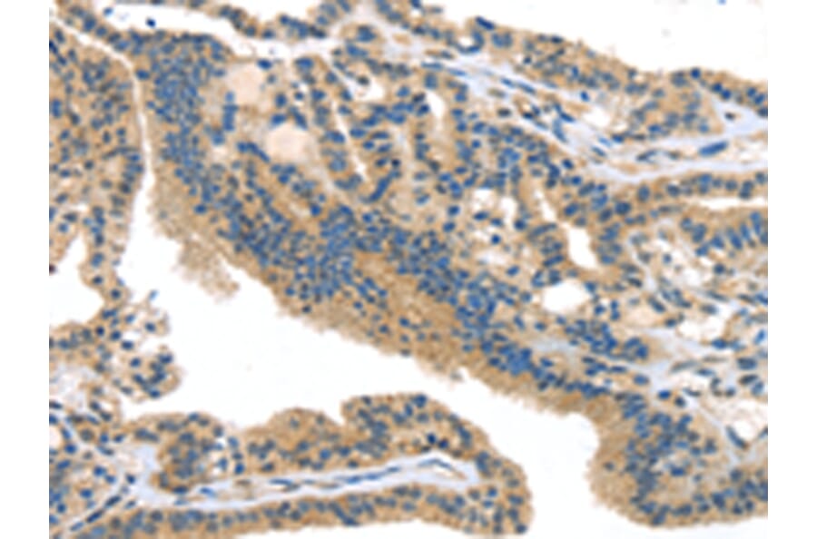 Immunohistochemistry - SMYD3 Antibody from Signalway Antibody (42761) - Antibodies.com