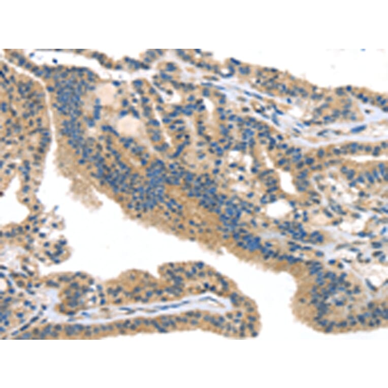 Immunohistochemistry - SMYD3 Antibody from Signalway Antibody (42761) - Antibodies.com