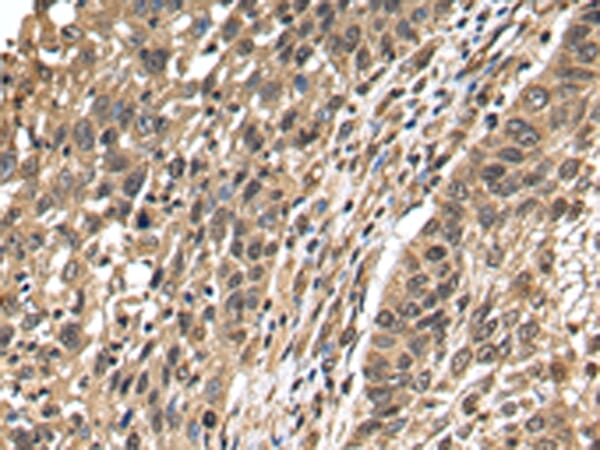Immunohistochemical analysis of paraffin-embedded Human lung cancer tissue using #42777 at dilution 1/25,