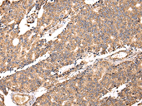 Immunohistochemical analysis of paraffin-embedded Human prostate cancer tissue using #42803 at dilution 1/20.