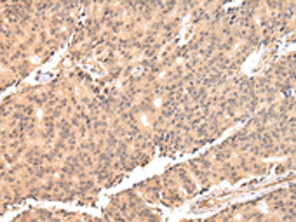 Immunohistochemical analysis of paraffin-embedded Human prostate cancer tissue using #42822 at dilution 1/25.