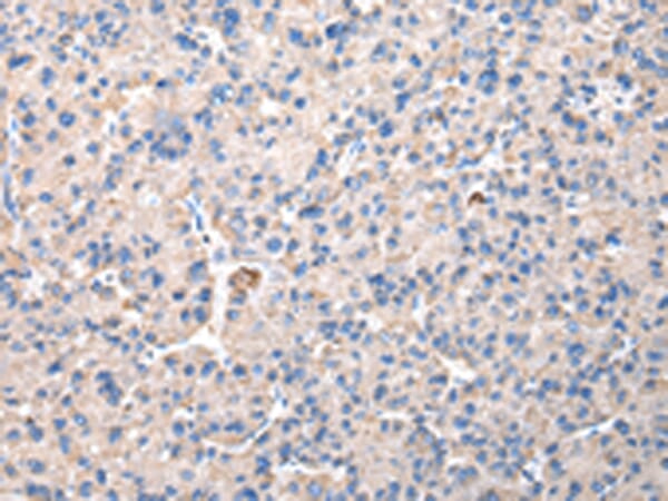 Immunohistochemical analysis of paraffin-embedded Human liver cancer tissue using #42835 at dilution 1/30.