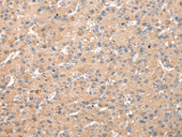 Immunohistochemical analysis of paraffin-embedded Human liver cancer tissue using #42850 at dilution 1/25.