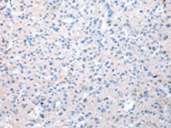 Immunohistochemical analysis of paraffin-embedded Human liver cancer tissue using #42851 at dilution 1/20,