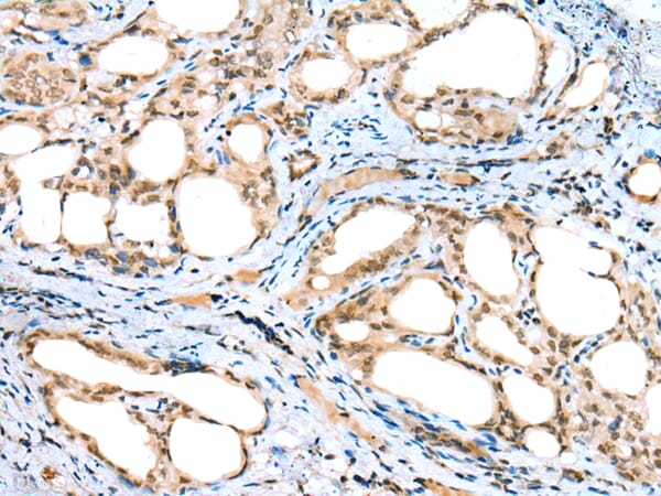 Immunohistochemical analysis of paraffin-embedded Human thyroid cancer tissue using #42903 at dilution 1/20.
