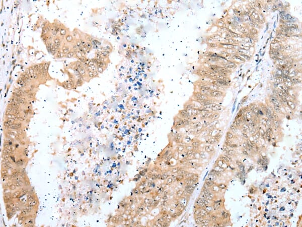 Immunohistochemical analysis of paraffin-embedded Human colorectal cancer tissue using #42903 at dilution 1/20.