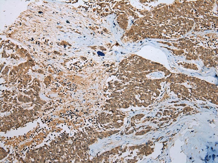Immunohistochemical analysis of paraffin-embedded Human Lung cancer tissue using #42907 at dilution 1/200.