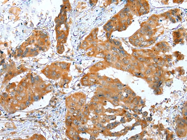 Immunohistochemical analysis of paraffin-embedded Human breast cancer tissue using #42909 at dilution 1/30.