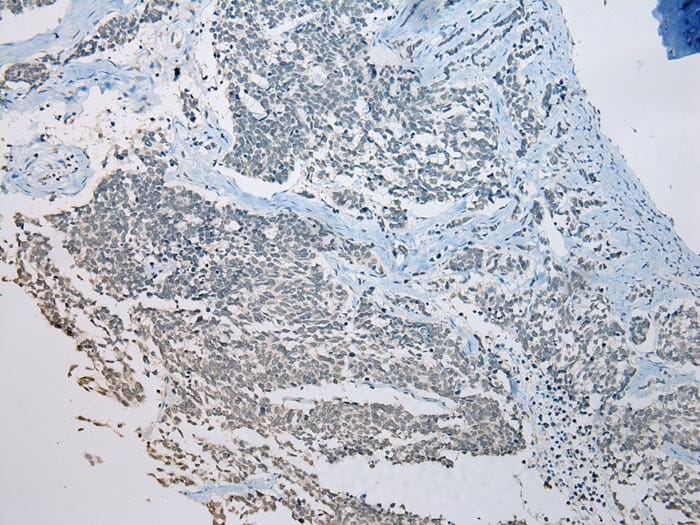 Immunohistochemical analysis of paraffin-embedded Human Lung cancer tissue using #42974 at dilution 1/200.