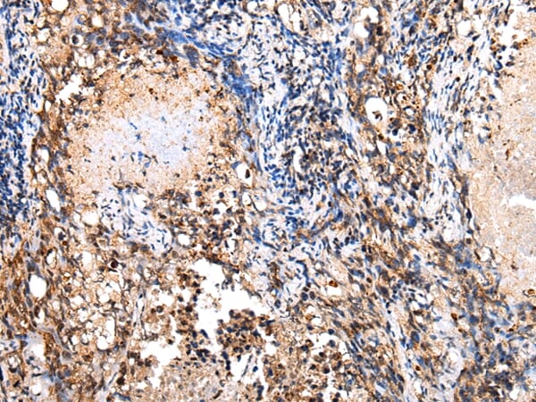 Immunohistochemical analysis of paraffin-embedded Human lung cancer tissue using #43278 at dilution 1/20,