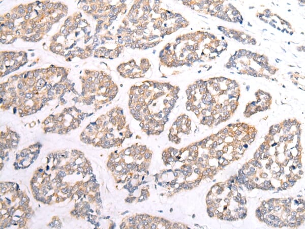 Immunohistochemical analysis of paraffin-embedded Human oesophagus cancer tissue using #43284 at dilution 1/20.