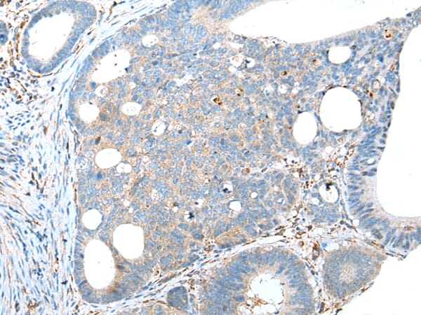 Immunohistochemical analysis of paraffin-embedded Human gastric cancer tissue using #43287 at dilution 1/20.