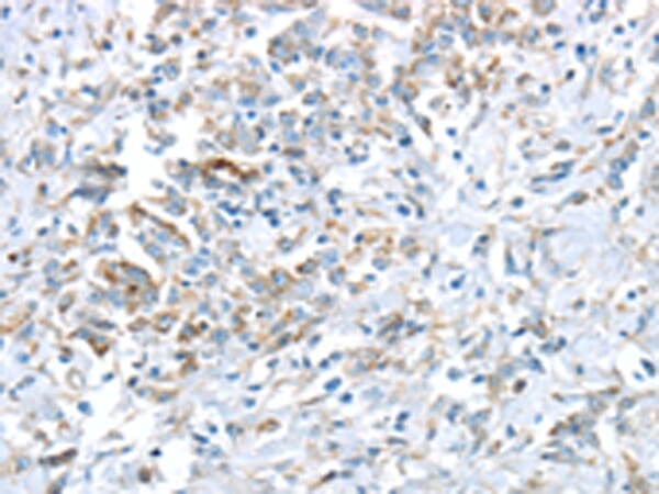 Immunohistochemical analysis of paraffin-embedded Human gastric cancer tissue using #43431 at dilution 1/30.