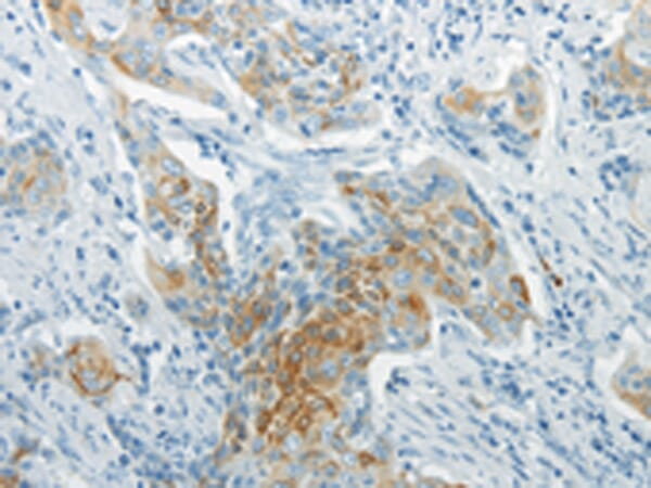 Immunohistochemical analysis of paraffin-embedded Human cervical cancer tissue using #43436 at dilution 1/20,