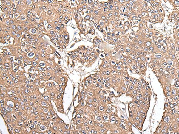 The image on the left is immunohistochemistry of paraffin-embedded Human prostate cancer tissue using KRT73 Antibody at dilution 1/100, on the right is treated with fusion protein. (Original magnification: x200)