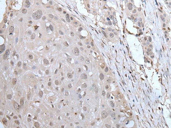 The image on the left is immunohistochemistry of paraffin-embedded Human oesophagus cancer tissue using YPEL2 Antibody at dilution 1/30, on the right is treated with fusion protein. (Original magnification: x200)