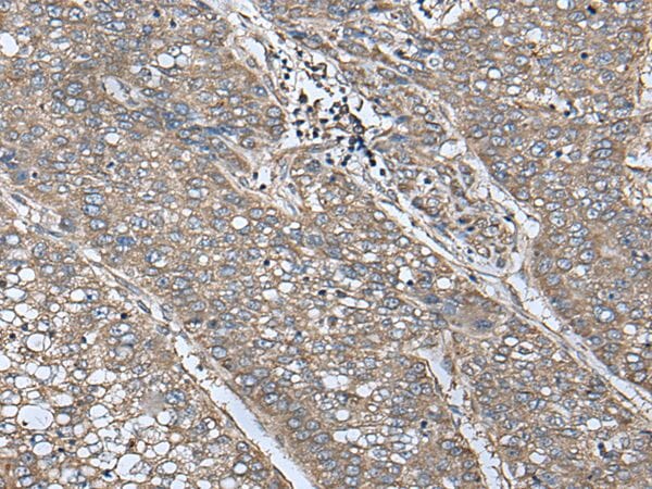 The image on the left is immunohistochemistry of paraffin-embedded Human liver cancer tissue using UQCRQ Antibody at dilution 1/100, on the right is treated with fusion protein. (Original magnification: x200)