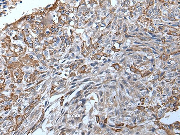 The image on the left is immunohistochemistry of paraffin-embedded Human lung cancer tissue using TRPC5 Antibody at dilution 1/20, on the right is treated with synthetic peptide. (Original magnification: x200)
