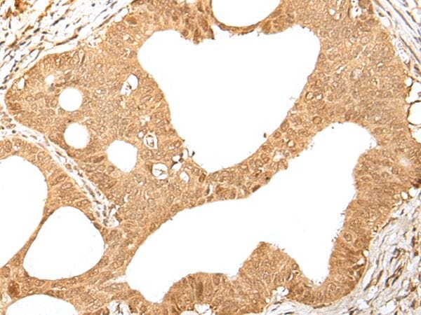The image on the left is immunohistochemistry of paraffin-embedded Human gastric cancer tissue using KMT2B Antibody at dilution 1/35, on the right is treated with synthetic peptide. (Original magnification: x200)