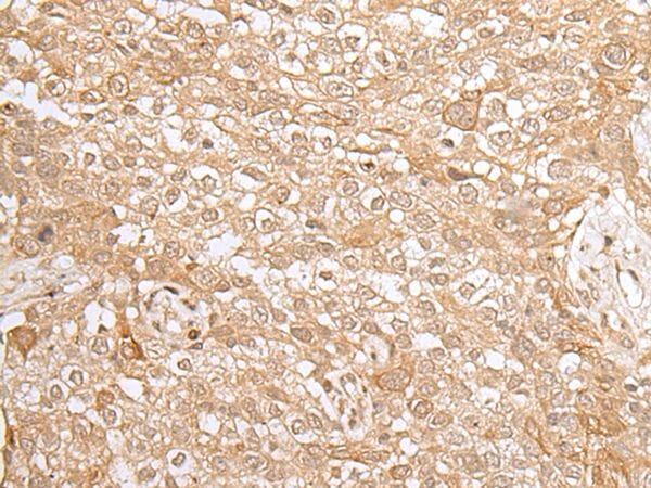 The image on the left is immunohistochemistry of paraffin-embedded Human lung cancer tissue using KMT2B Antibody at dilution 1/35, on the right is treated with synthetic peptide. (Original magnification: x200)