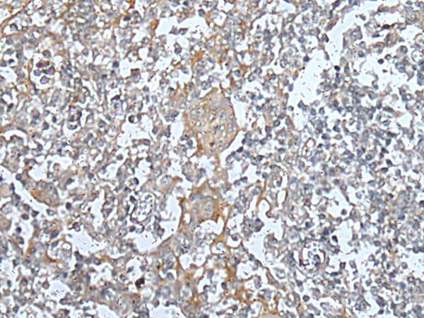 The image on the left is immunohistochemistry of paraffin-embedded Human tonsil tissue using KIF14 Antibody at dilution 1/35, on the right is treated with synthetic peptide. (Original magnification: x200)