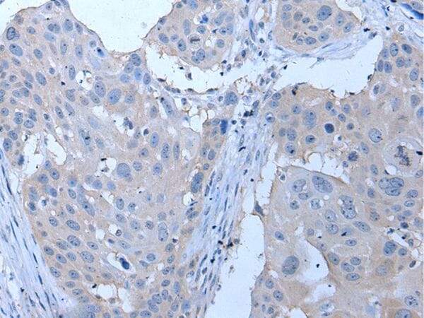 The image on the left is immunohistochemistry of paraffin-embedded Human oesophagus cancer tissue using YPEL4 Antibody at dilution 1/30, on the right is treated with synthetic peptide. (Original magnification: x200)