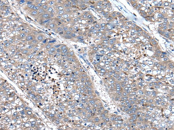 The image on the left is immunohistochemistry of paraffin-embedded Human liver cancer tissue using XIRP1 Antibody at dilution 1/100, on the right is treated with synthetic peptide. (Original magnification: x200)