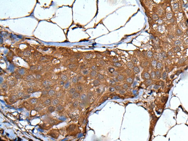 The image on the left is immunohistochemistry of paraffin-embedded Human breast cancer tissue using VSIG1 Antibody at dilution 1/35, on the right is treated with synthetic peptide. (Original magnification: x200)