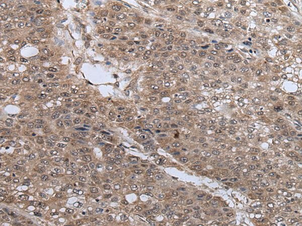 The image on the left is immunohistochemistry of paraffin-embedded Human liver cancer tissue using UBE4B Antibody at dilution 1/40, on the right is treated with synthetic peptide. (Original magnification: x200)