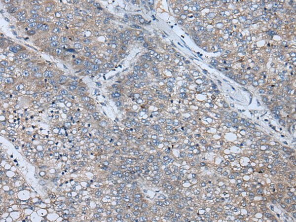 The image on the left is immunohistochemistry of paraffin-embedded Human liver cancer tissue using BICD2 Antibody at dilution 1/100, on the right is treated with synthetic peptide. (Original magnification: x200)