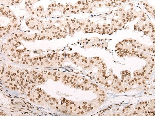The image on the left is immunohistochemistry of paraffin-embedded Human liver cancer tissue using VPS51 Antibody at dilution 1/100, on the right is treated with synthetic peptide. (Original magnification: x200)