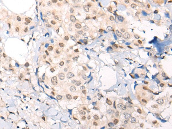The image on the left is immunohistochemistry of paraffin-embedded Human breast cancer tissue using VPS51 Antibody at dilution 1/100, on the right is treated with synthetic peptide. (Original magnification: x200)