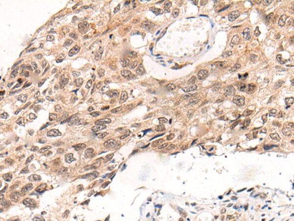 The image on the left is immunohistochemistry of paraffin-embedded Human oesophagus cancer tissue using KNOP1 Antibody at dilution 1/100, on the right is treated with synthetic peptide. (Original magnification: x200)