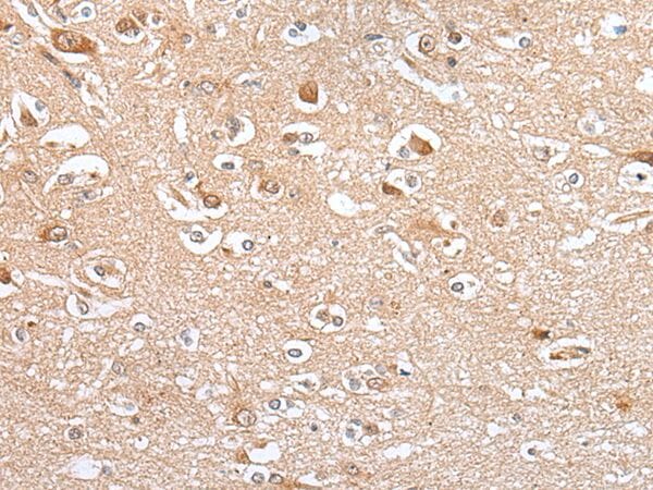 The image on the left is immunohistochemistry of paraffin-embedded Human brain tissue using CES4A Antibody at dilution 1/20, on the right is treated with synthetic peptide. (Original magnification: x200)