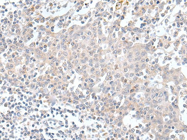 The image on the left is immunohistochemistry of paraffin-embedded Human tonsil tissue using KCNH1 Antibody at dilution 1/20, on the right is treated with synthetic peptide. (Original magnification: x200)