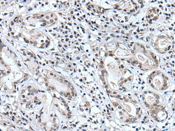 The image on the left is immunohistochemistry of paraffin-embedded Human lung cancer tissue using BSPRY Antibody at dilution 1/35, on the right is treated with synthetic peptide. (Original magnification: x200)