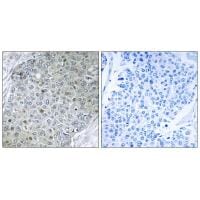 Immunohistochemistry analysis of paraffin-embedded human breast carcinoma tissue, using ETV4 antibody #33772.