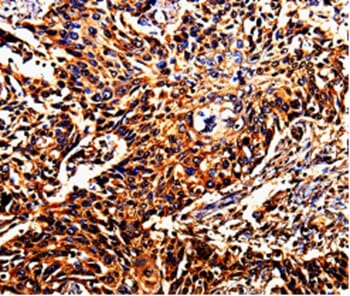 Immunohistochemical analysis of paraffin-embedded Human oesophagus cancer tissue using #35555 at dilution 1/10.