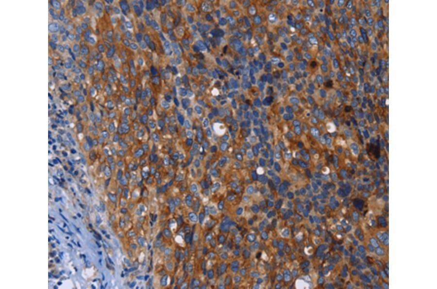 Immunohistochemistry - MSLN Antibody from Signalway Antibody (35823) - Antibodies.com
