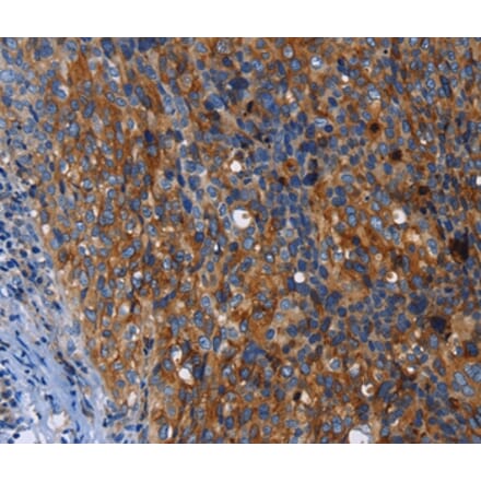 Immunohistochemistry - MSLN Antibody from Signalway Antibody (35823) - Antibodies.com