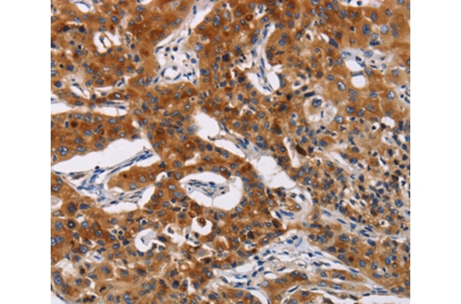 Immunohistochemistry - MSLN Antibody from Signalway Antibody (35823) - Antibodies.com