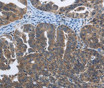 Immunohistochemical analysis of paraffin-embedded Human ovarian cancer tissue using #35934 at dilution 1/40.