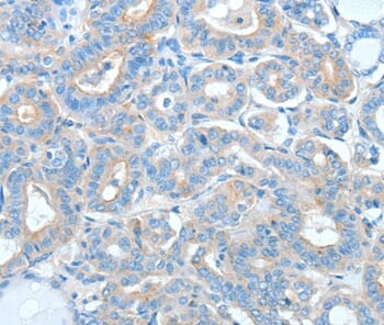 Immunohistochemical analysis of paraffin-embedded Human thyroid cancer tissue using #36062 at dilution 1/20.