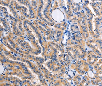 Immunohistochemical analysis of paraffin-embedded Human oesophagus cancer tissue using #36080 at dilution 1/30.