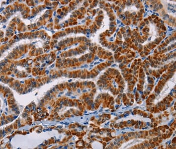 Immunohistochemical analysis of paraffin-embedded Human thyroid cancer tissue using #36083 at dilution 1/25.