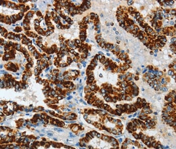 Immunohistochemical analysis of paraffin-embedded Human thyroid cancer tissue using #36242 at dilution 1/40.