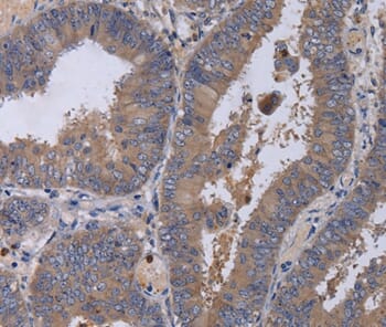 Immunohistochemical analysis of paraffin-embedded Human colon cancer tissue using #36619 at dilution 1/50.