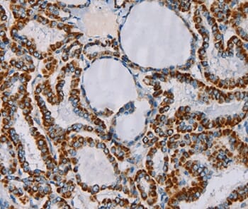 Immunohistochemical analysis of paraffin-embedded Human thyroid cancer tissue using #36622 at dilution 1/55.