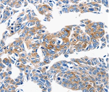 Immunohistochemical analysis of paraffin-embedded Human lung cancer tissue using #36780 at dilution 1/50.